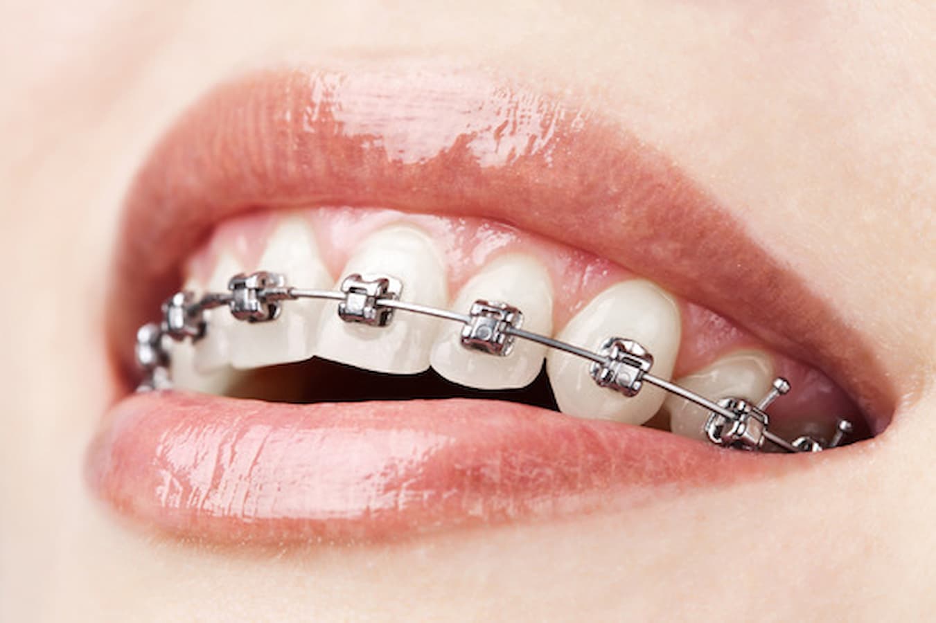 Braces & Implants Braces & Implants