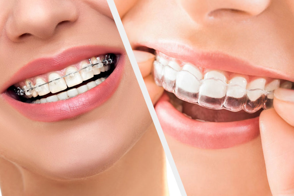 Clear aligners Clear aligners