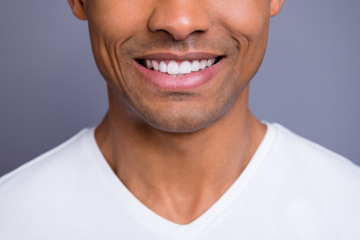 Veneers Veneers