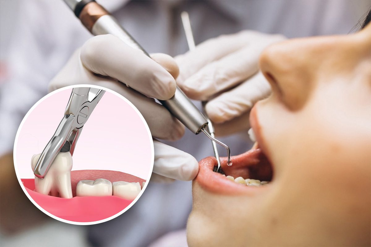 Wisdom-Tooth-Extraction Wisdom-Tooth-Extraction